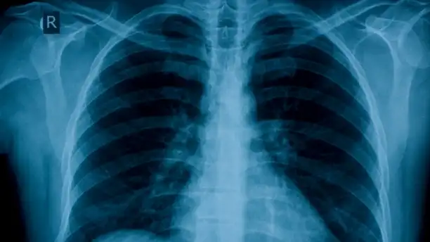 mucus in lungs x ray