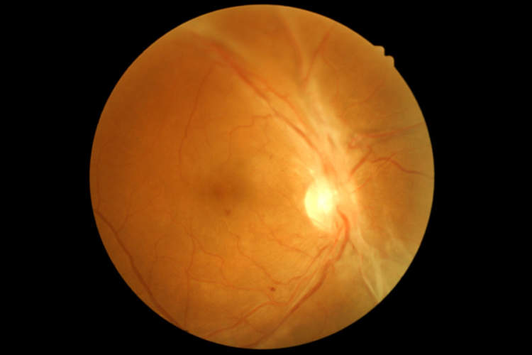 视网膜扫描显示糖尿病性视网膜病