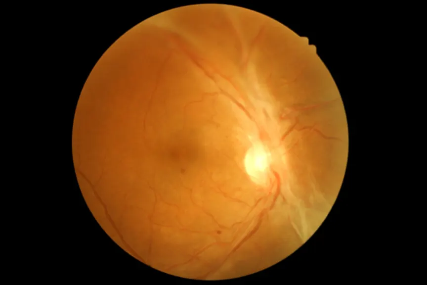 视网膜扫描显示糖尿病视网膜病变