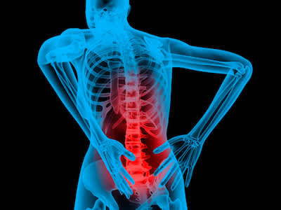 背痛患者的X光片类型图像。