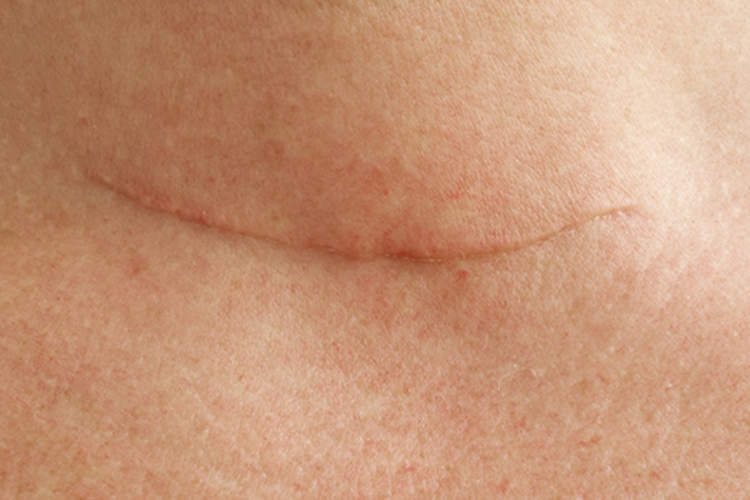 颈部手术疤痕。