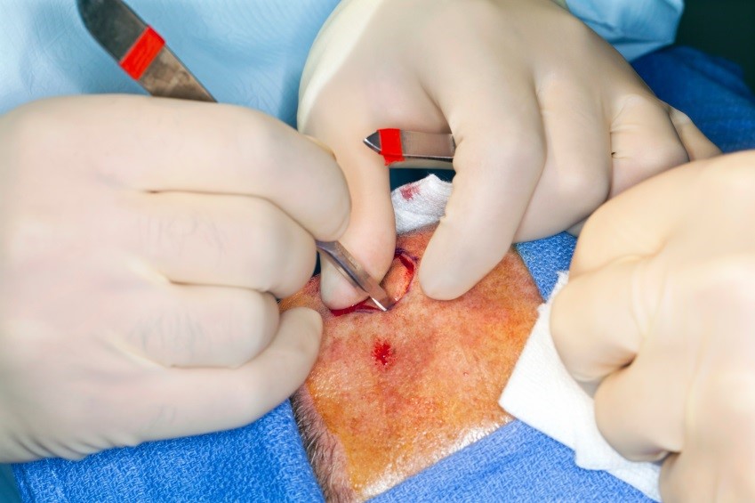 活检可能有助于检测黑色素瘤的扩散