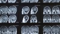 核磁共振成像可能有助于检测ADHD