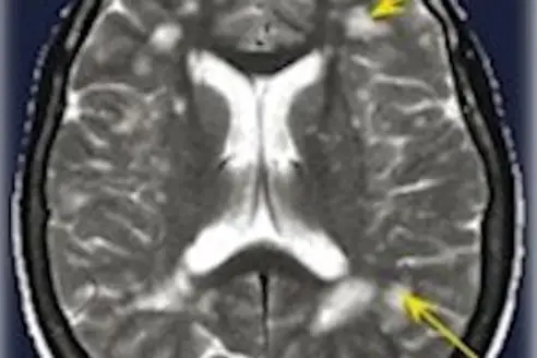 Migraines and White Matter Lesions - What We Should Know