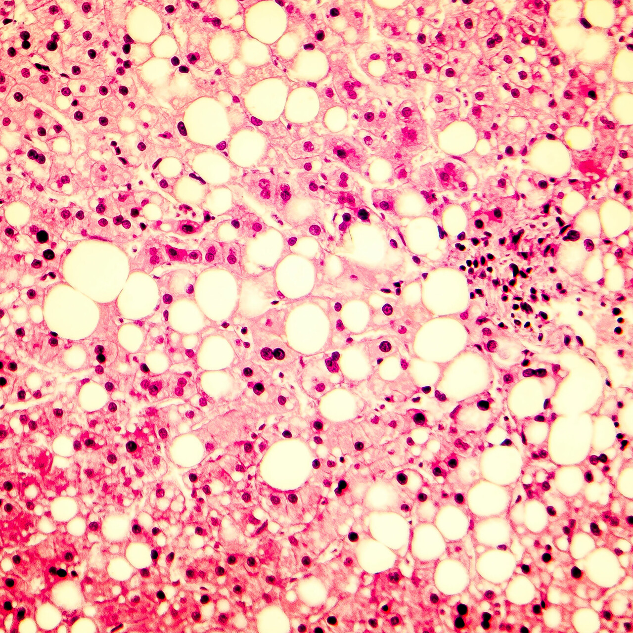 脂肪肝的显微照片