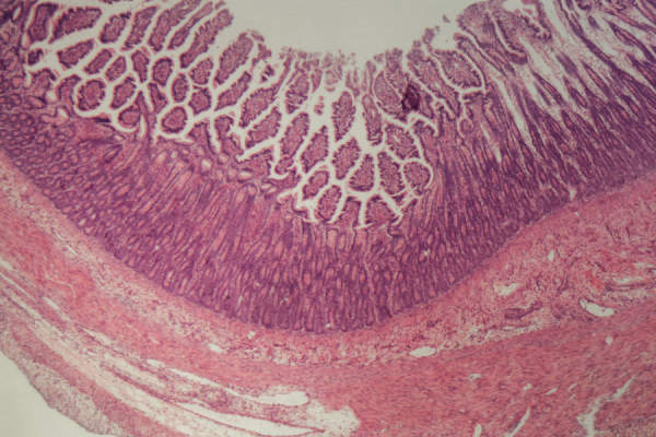 结肠炎人类大肠部分的显微镜照片
