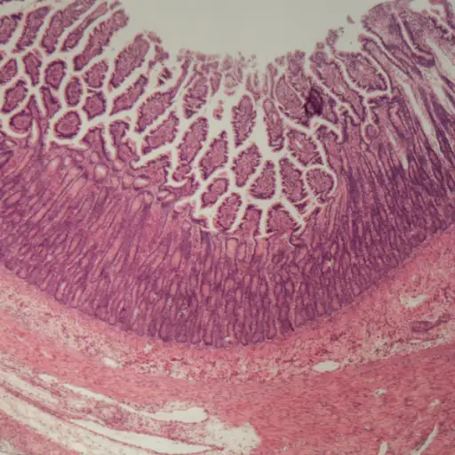 人大肠部分的显微镜照片与结肠炎