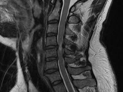 颈椎管狭窄的MRI表现。