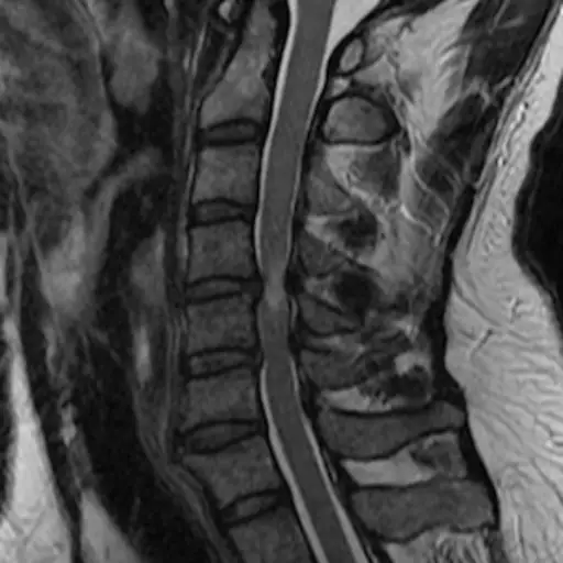 MRI of cervical spinal canal stenosis.