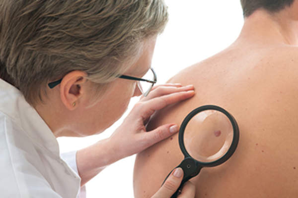 皮肤科医生在检查一个男人背上的痣。