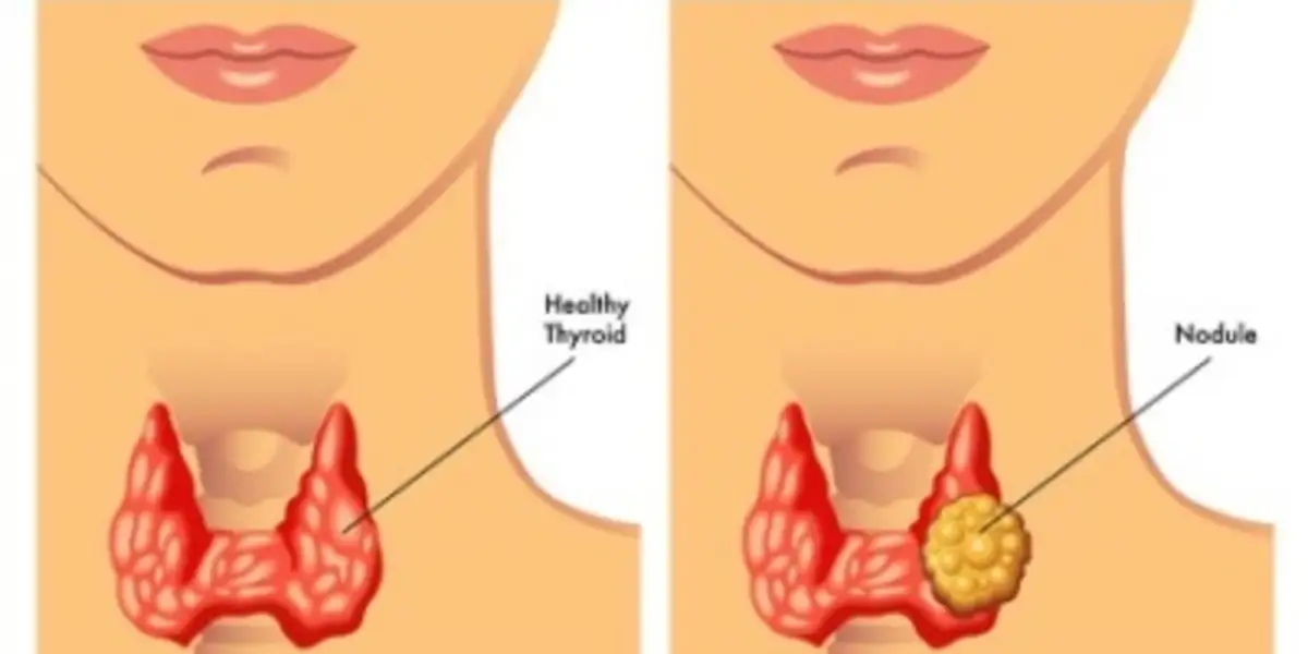 Thyroid Nodules: Symptoms, Causes, Diagnosis, & Treatment