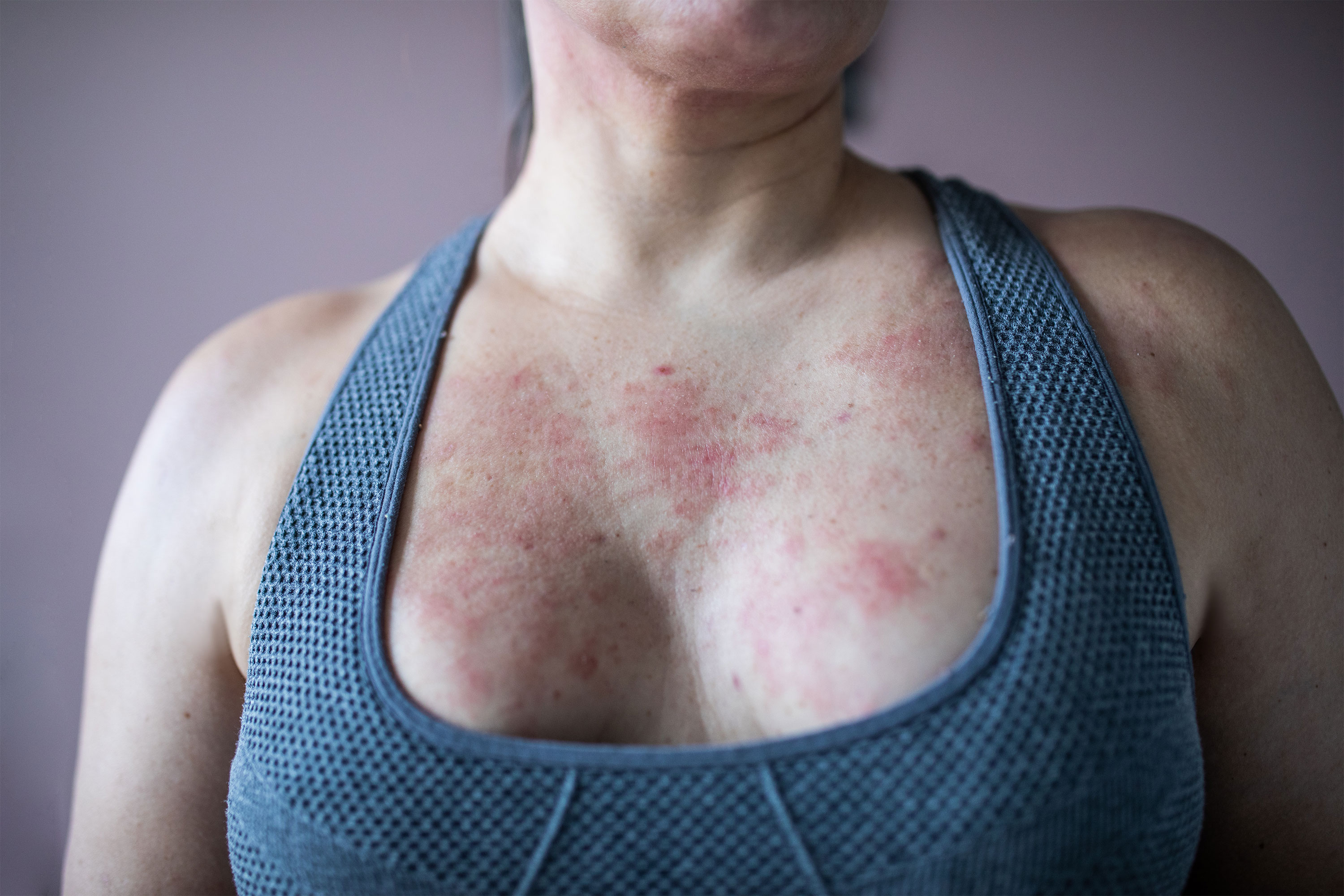Breast Eczema: Symptoms, Causes, and Treatment