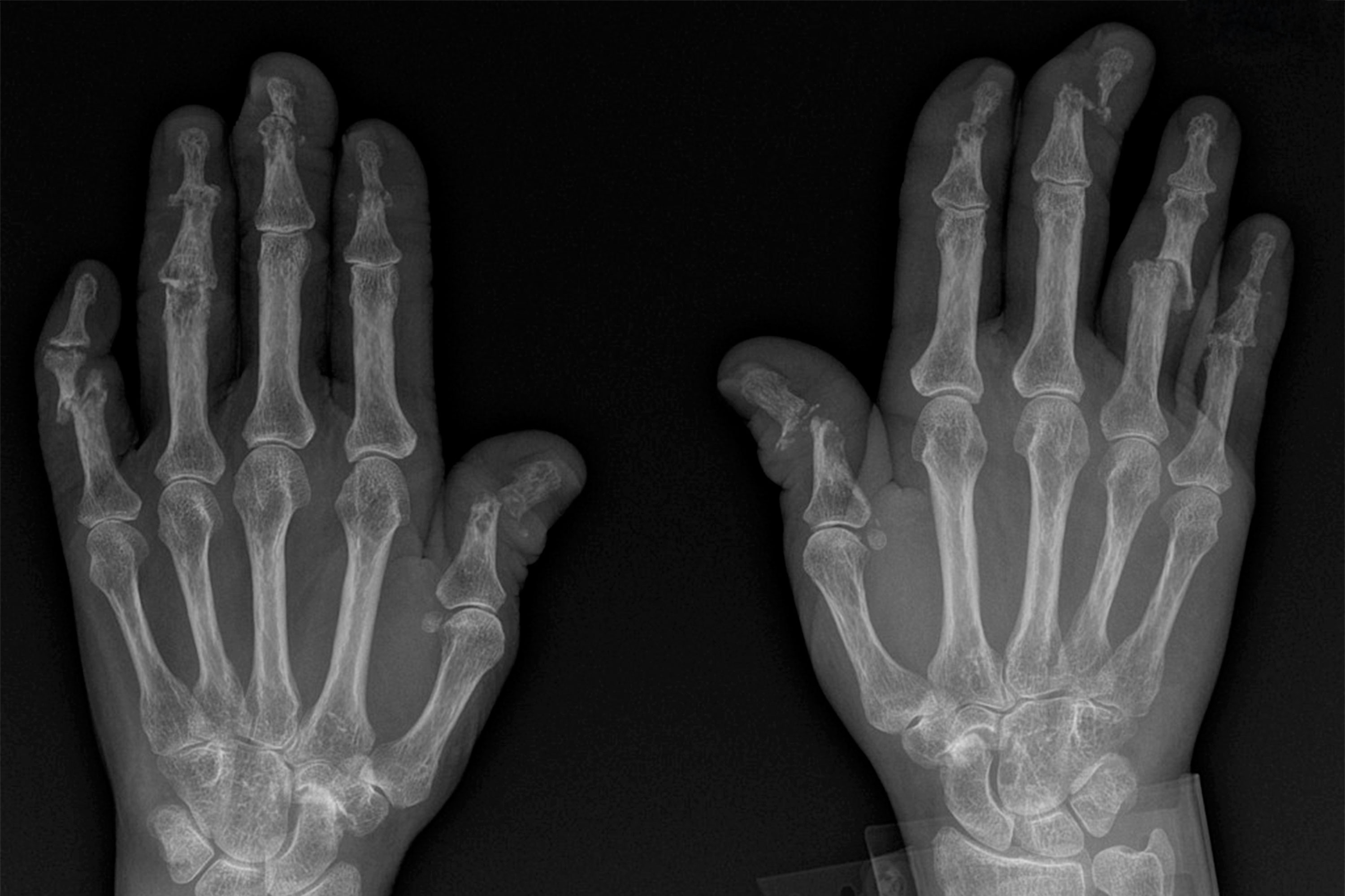 Psoriatic Arthritis X-Ray: What to Expect