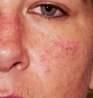 rosacea2.jpg