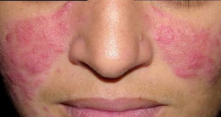 rosacea3.jpg