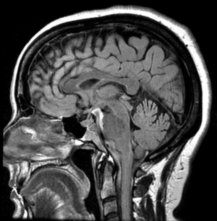 丽莎的MRI从2016年10月25日扫描从矢状T2 FLAIR序列。无病变可以在这里看到。