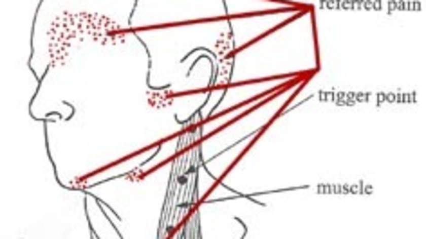 What Is A Myofascial Trigger Point And Its Relationship To