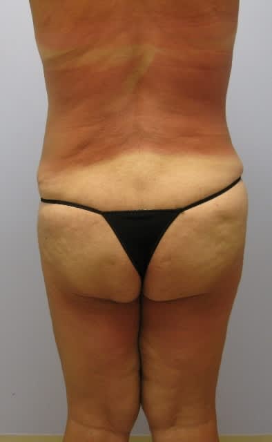 buttocks