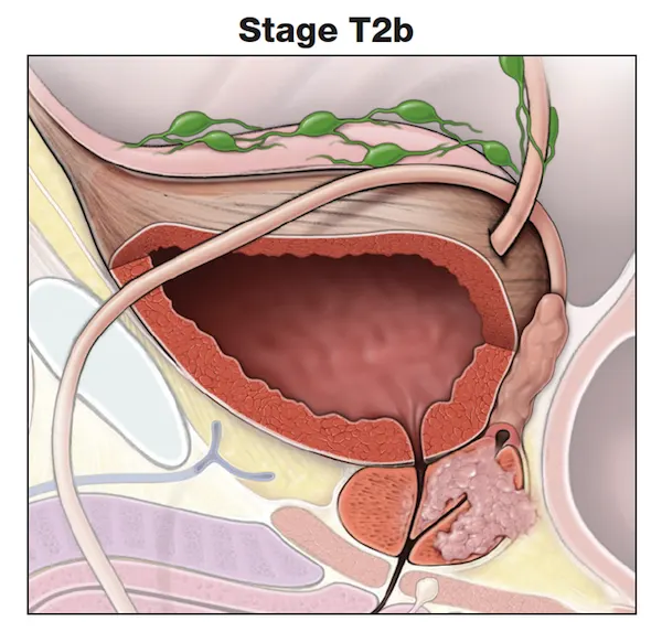 了解前列腺癌的肿瘤分期- t2b -前列腺分期