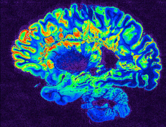 来自多发性硬化症患者的一个固定大脑半球的高分辨率梯度回声MRI伪彩色图像