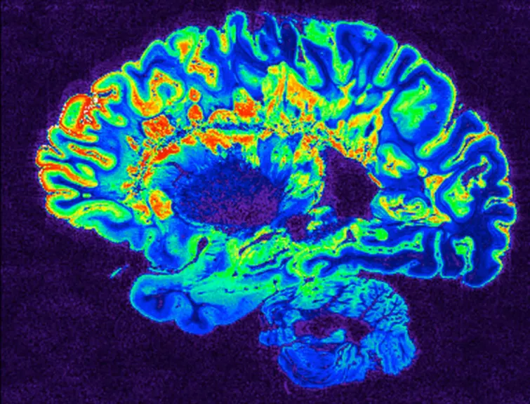 假色图像的高分辨率gradient-echo MRI扫描一个固定的多发性硬化症患者的大脑半球