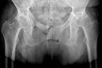 A hip radiograph of a patient with psoriatic arthritis