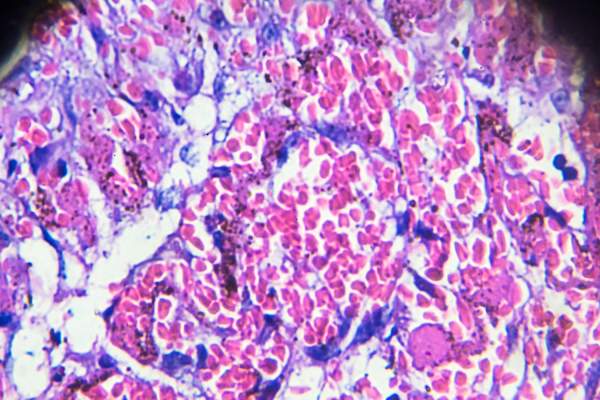 显微镜下人类病理标本血栓