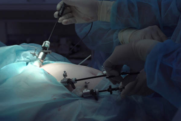 使用腹腔镜设备进行手术。