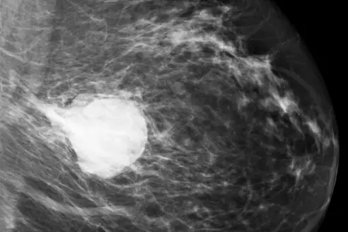 Stage 1 breast cancer