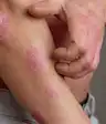 psoriasis