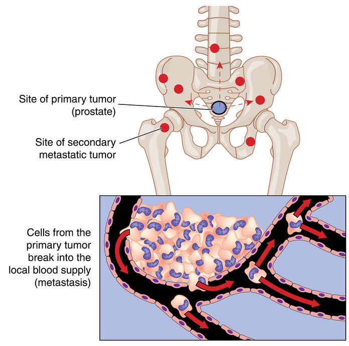 Chordoma Is the Most Common Malignant Primary Bone Cancer in the ...