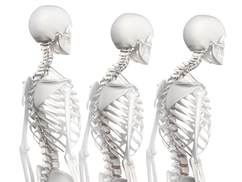 Human Spine Posture Back View Stock Illustration - Illustration of