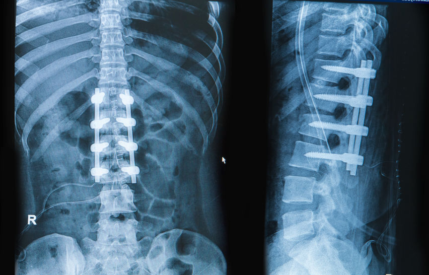 Spinal cord stimulator - Wikipedia