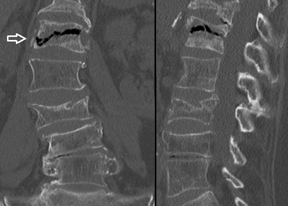 Avascular Necrosis: What is it?