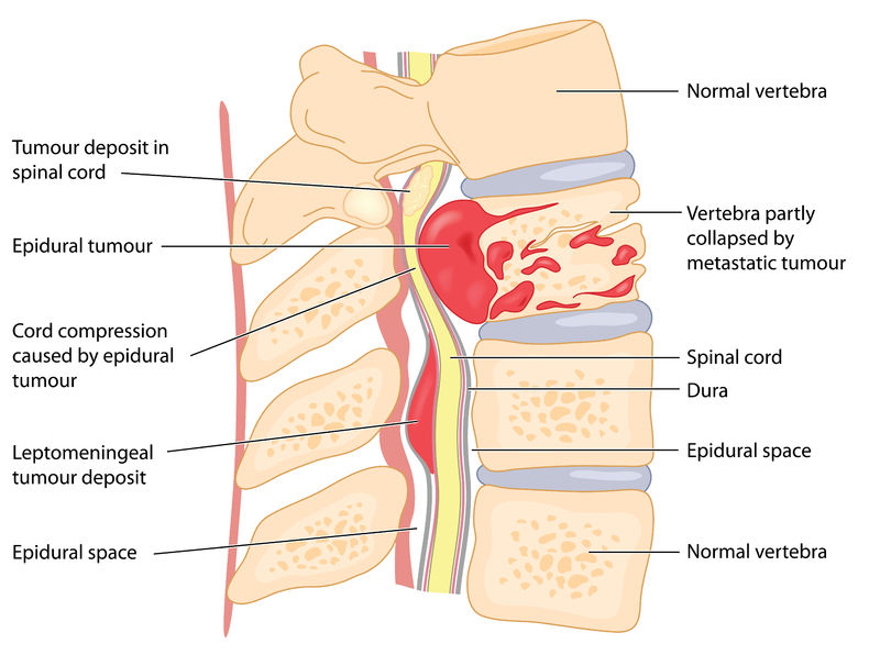 健康・医学 Cancer in the spine Vertebral Tumor - Hart Garner, MD - Minnesota Spinal