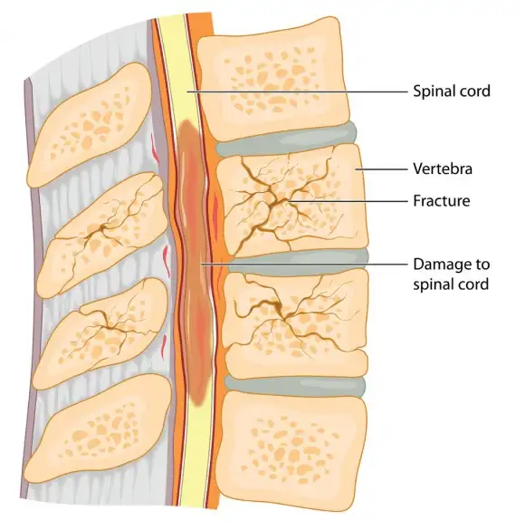 Vertebral Compression Fractures : Advanced Pain Management Center