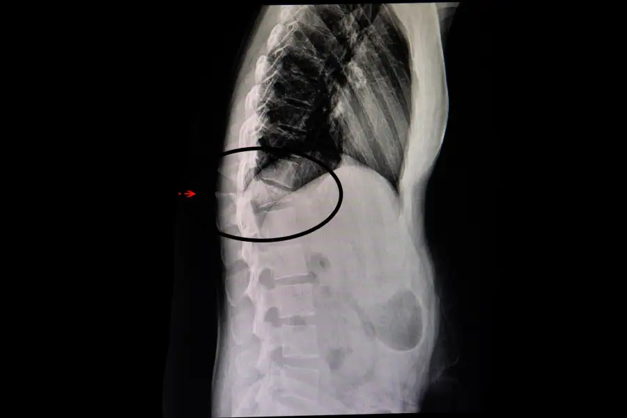 Spinal compression fracture, Radiology Reference Article