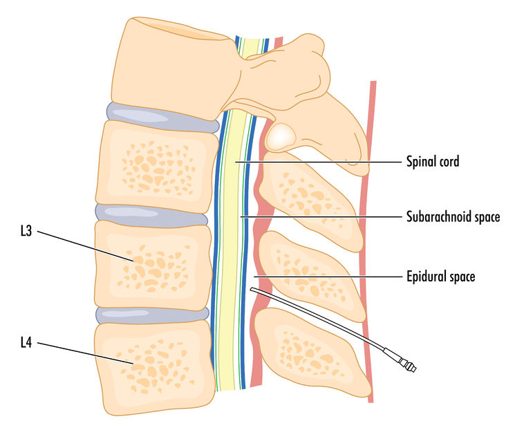 Understanding a Trial Run With a Spinal Cord Stimulator: Republic