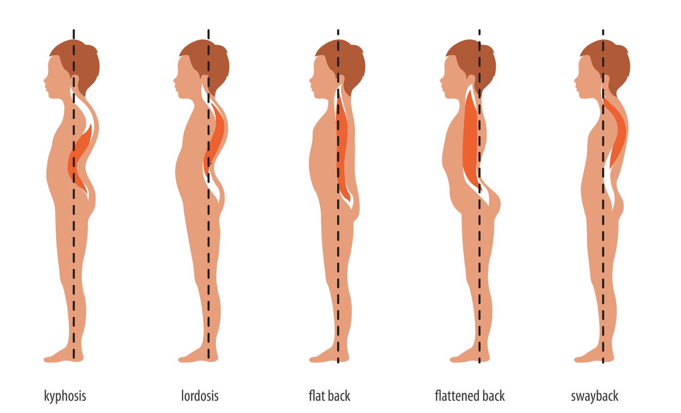 What it Can Mean to Have a Slight Curve in the Spine