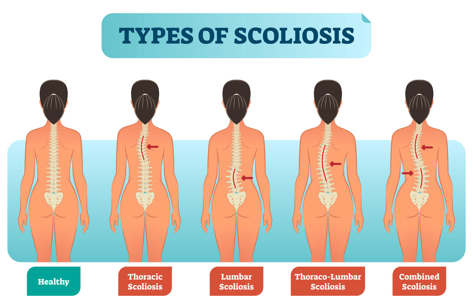 Scoliosis in Teens: What a Back Brace Can and Can't Accomplish