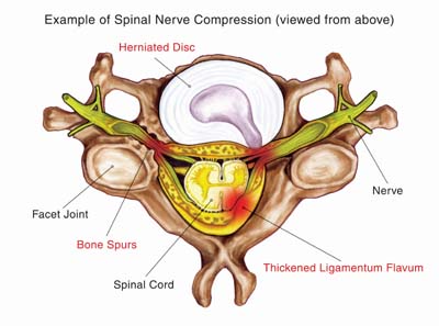 compressed nerve in neck
