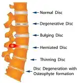 The Aging Spine and Degenerative Disc Disease