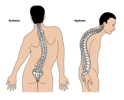 Type of scoliosis of spine - Spine - Pillow