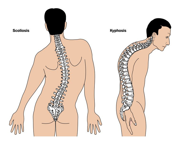 Kyphosis: What It Is, Causes, Symptoms, Types & Treatment