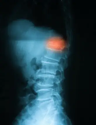 Spinal Compression Fracture  Top Orthopedic in Boca Raton