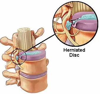 Common Herniated Disc Procedures
