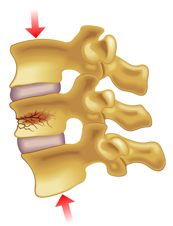 Compression Fracture Diagram