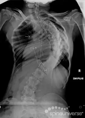 Nonsurgical Treatment Options for Scoliosis - OrthoInfo - AAOS