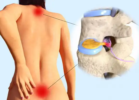 Slipped (Herniated) Disc - Causes and Symptoms