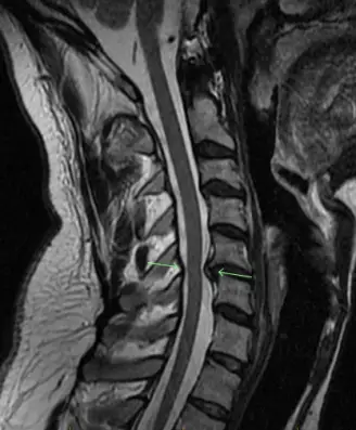 Cervical Alignment and its Impact on Spinal Health - Complete Orthopedics